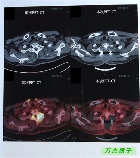 骨肉瘤质子治疗一年后复查，PETCT 显示肿块完全消失 － 丁香园