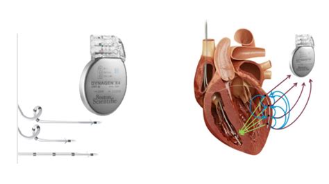 专家解答：安装心脏起搏器后，患者最关心的7个问题