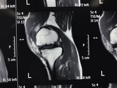 磁共振成像MRI膝盖后部角中枢断裂的眼泪高清图片下载-正版图片503526674-摄图网