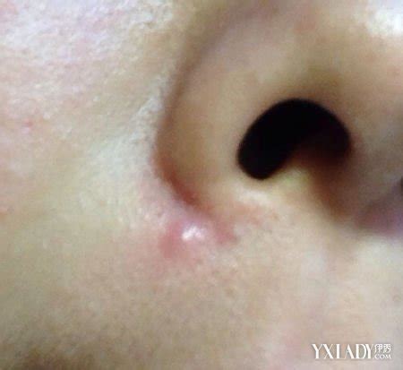 鼻子上长脓包型痘痘 顾名思义就是这种痘痘很容易流