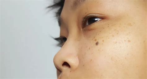 脸上的斑斑点点都是什么？如何安全又有效地清除它们？