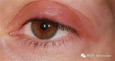 肿眼泡全切双眼皮 去脂去皮 双眼皮，开眼角 记录一下 。（照片有点吓人）手术医生一定要多了解！！！ - 知乎