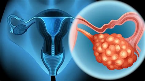 更年期卵巢囊肿怎么办？先知道所出现卵巢囊肿是什么性质-更年期综合征治疗-复禾健康