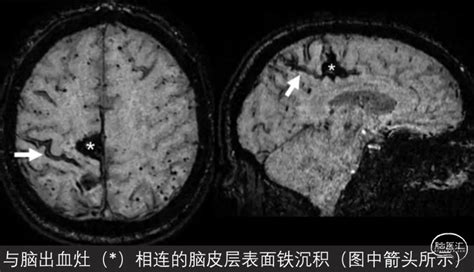 成功救治重型颅脑损伤患者一例丨颅脑创伤-神经重症病例周刊（第58期） - 脑医汇 - 神外资讯 - 神介资讯