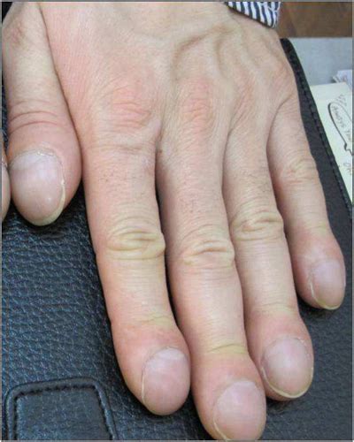 大拇指手指甲凹凸不平 到底是什么原因引起|凹凸|指甲|手指甲_新浪新闻