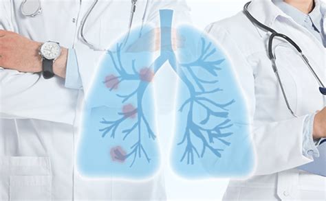肺癌可分为哪几种呢？ - 知乎