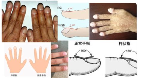 杵状指与正常手指对比，发现早期肺癌症状一个很简单的方法-癌症肿瘤-114挂号网