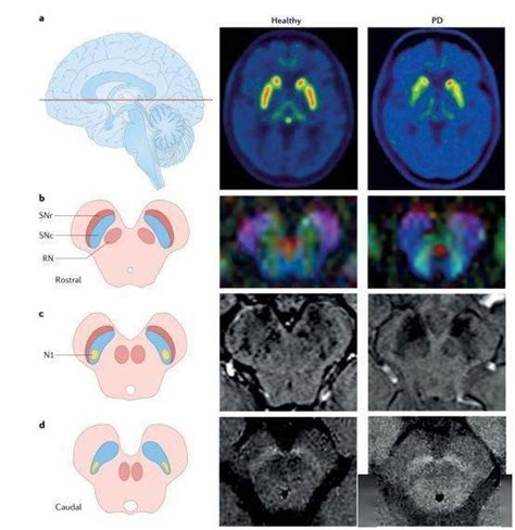 Nat Rev Neurol：帕金森病多巴胺能变性的多模式脑和视网膜成像_神经_病理_黑色素