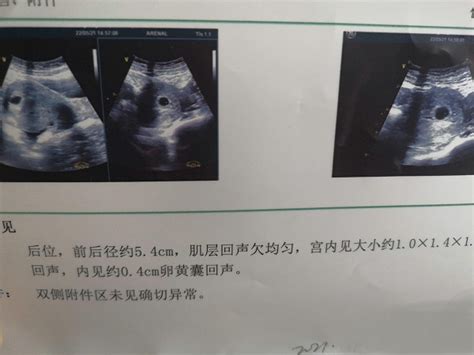 孕囊大小对照表50天，孕囊大小看男女