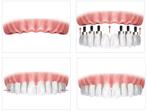 allon4和allon6全口种植牙详细步骤、价格及弊端超全解析 - 口腔健康 - 毛毛网