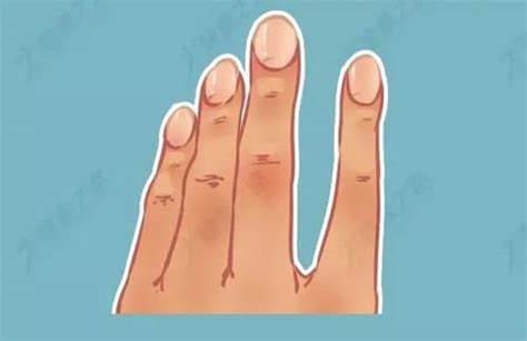 杵状指的辨别、就医检查及预防 - 健康驱动力