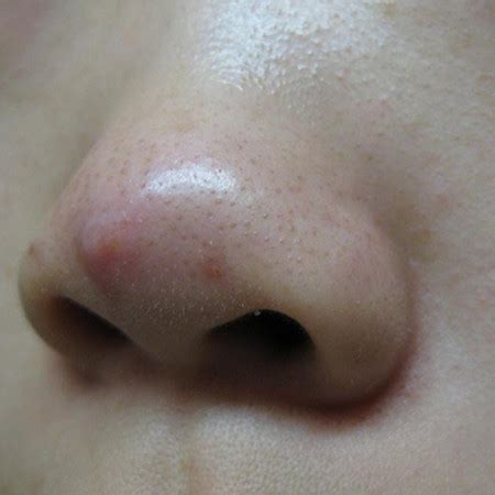 【图】你们知道鼻子周痘痘是什么原因吗 这些妙招让痘痘远离你_鼻子周痘痘是什么原因_伊秀美容网|yxlady.com