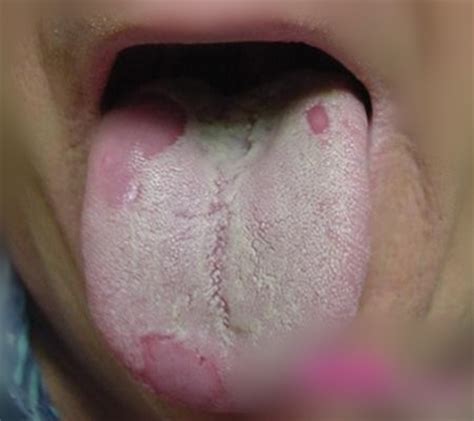 经常舌头发麻怎么回事?中医：警惕三种危险疾病易导致舌头发麻__凤凰网