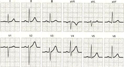 正常心电图波、间期和段特点与正常值-心血管-医学