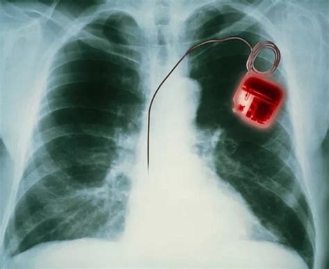 安装心脏起搏器的患者该如何判定死亡？_临床