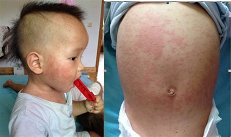 宝宝长疹子：10种新生儿及小婴儿常见皮疹(含图片)-京东健康