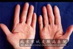 汗疱疹皮疹的特点是什么_汗疱疹_北京京城皮肤医院(北京医保定点机构)