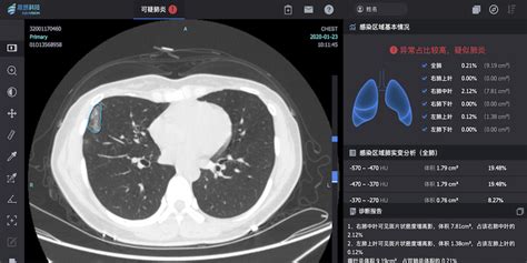解密新冠肺炎CT影像AI筛查 - 知乎