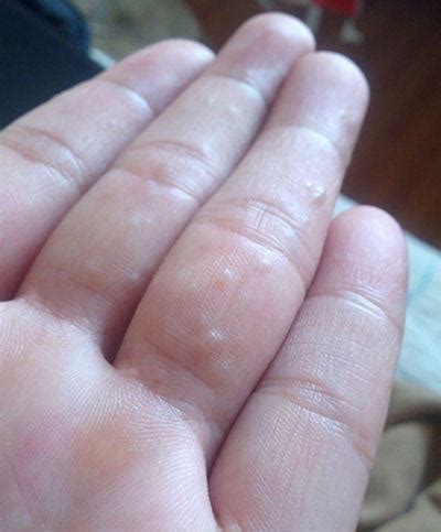 手指上长了很多不痛不痒的小疙瘩，像小水泡但是干的，这是怎么回事呢？ - 知乎