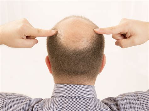 专家指出防止秃头出现的方法 - 2020年11月28日, 俄罗斯卫星通讯社