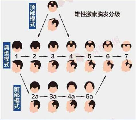中华医学会 科普图文 男性脱发，是雄激素过多惹的祸？