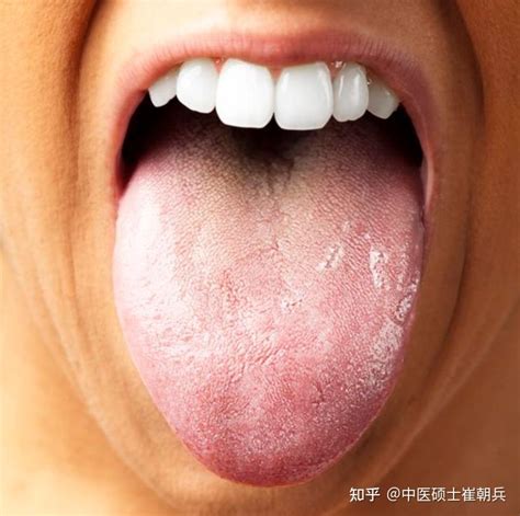 最全舌诊图解！中医教你4大方法，看舌头懂健康，收藏备用 - 知乎