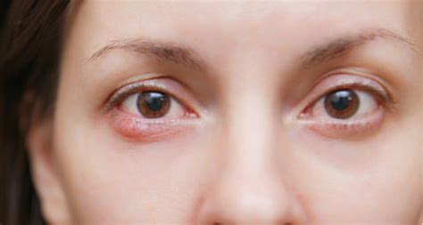 眼睛越柔越痒！过敏性结膜炎怎么治能根除？对症治疗很关键-12健康