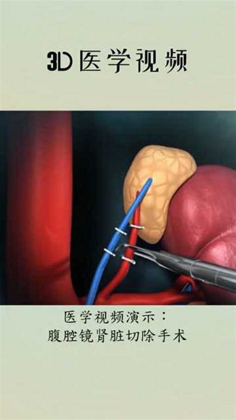 一颗长了肿瘤的肾是怎样被保住的-重庆医科大学附属第一医院