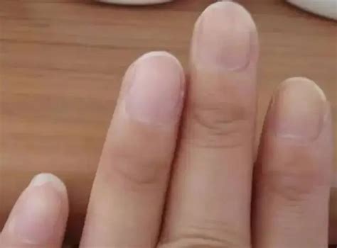 【郑州肤康皮肤病医院】灰指甲全面总结！教你认清灰指甲的危害-健康160