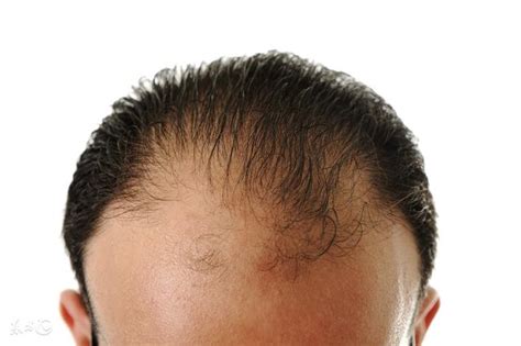 美国研究出治疗脱发新基因，可彻底根治脱发