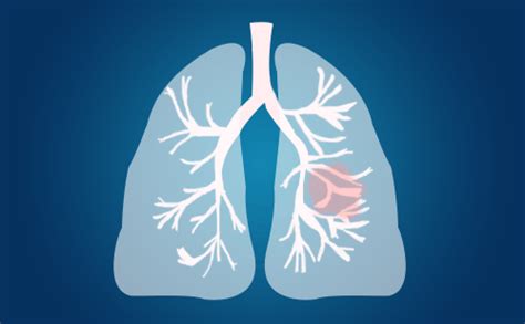 如何发现早期肺癌？疑似早期肺癌的三个信号，一个都不能忽视！ - 知乎
