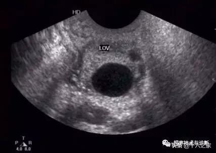 病例3 正常子宫(黄体期)-妇产超声读片-医学
