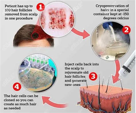追踪hbw毛囊克隆技术的新进展,并揭示毛囊克隆和植发的区别,毛发移植-8682赴韩整形网