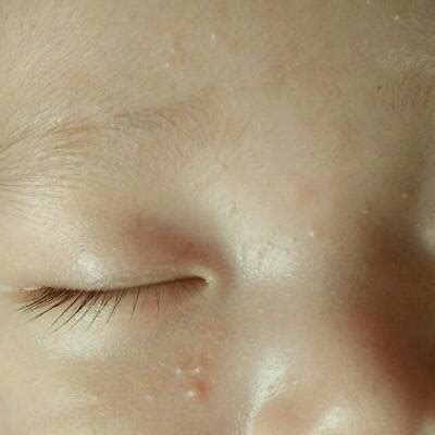宝宝脸上的小红点是什么？ - 百度宝宝知道