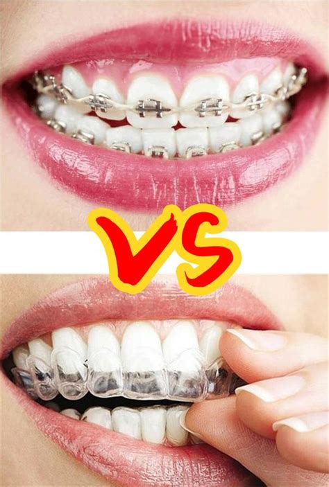 钢牙还是隐形牙？你该怎么选？ - 知乎