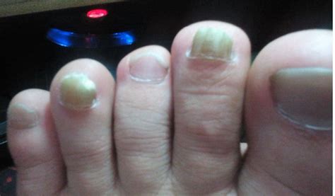 在家治疗灰指甲，教你一个方法，灰指甲再不复发|灰指甲|癣菌|尿素_新浪新闻