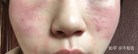 脸颊两侧发红发热起皮但是不痛不痒经常反反复复的出现