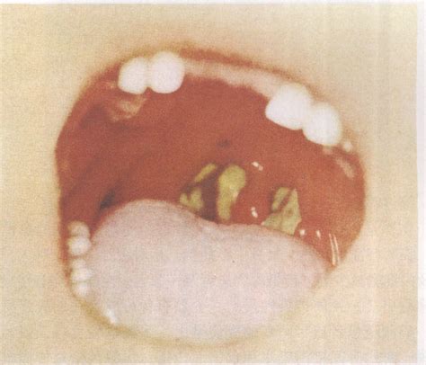 第三节 白喉-常见传染病与性病-医学