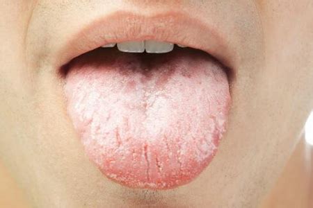 舌头发麻是什么原因？这四个原因导致别视而不见 _症状