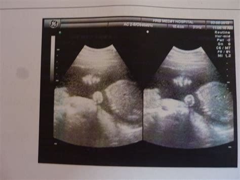 产前超声：胎儿颅面部畸形 - 丁香园