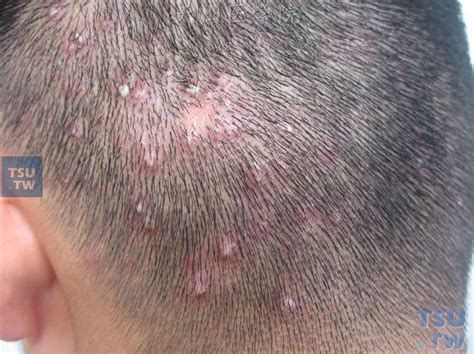 秃发性毛囊炎（bald folliculitis）的症状表现 - 皮肤病学 - 天山医学院