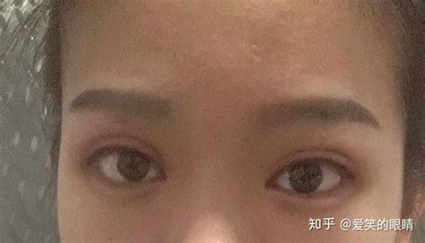 在新加坡孩子眼皮上长了麦粒肿怎么办？