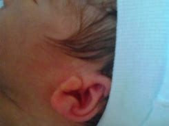 宝宝的耳朵 宝宝的耳朵被耳屎堵住了怎么办