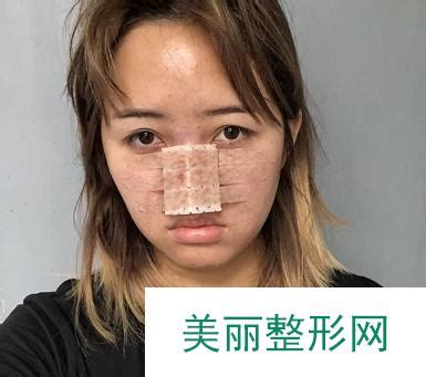 北京亿美国际医疗美容整形医院做面部年轻化手术效果如何？附上案-欣美整形网