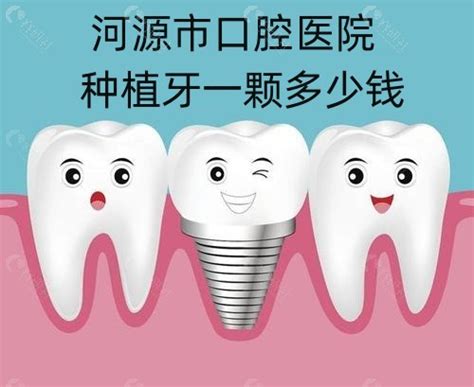 绍兴柯桥牙科种植牙5680元起就能做，韩国登腾价格太优惠！ - 牙度口腔