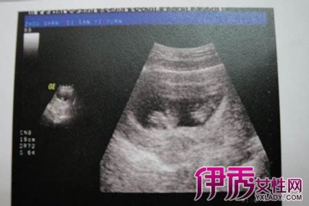【异卵双胞胎b超图】【图】异卵双胞胎b超图片欣赏 带你了解怀孕的检查项目(2)_伊秀亲子|yxlady.com