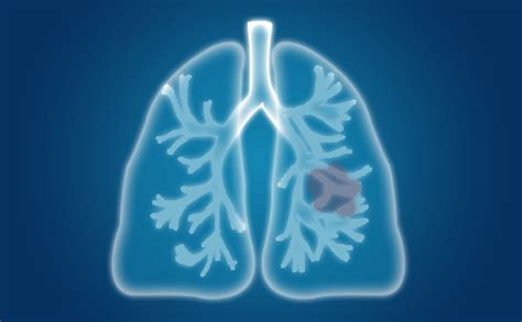 肺癌的发病原因及机制-肺癌病因-复禾健康