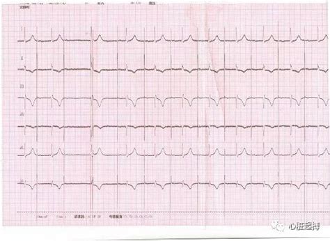 心电图图例分析：心房起搏心律AAI模式-专业文章