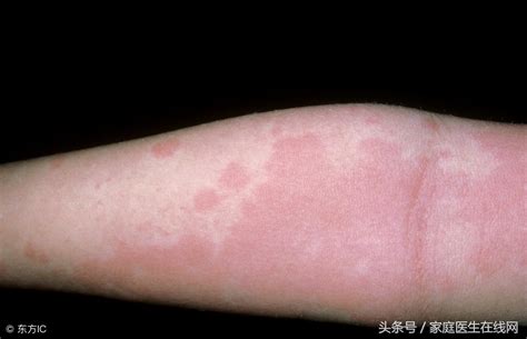 皮炎湿疹反复发作，越抓越痒？可能和这5种不良习惯密切相关...... - 知乎