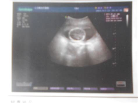 请各位专家帮我看一下怀孕19周5天的B超单子 双顶径4.5CM.胎心率148.腹围13.6CM.股 - 百度宝宝知道